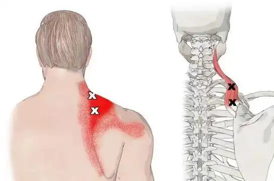 为啥后背疼僵硬不出意外是筋膜炎告知2个省钱的治疗方法