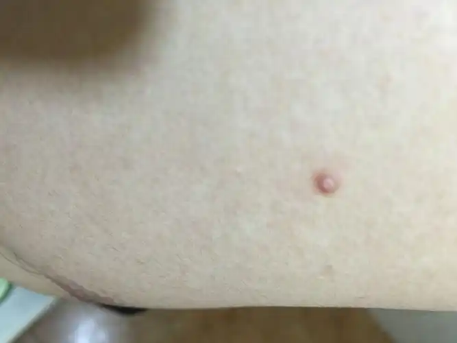 身上长了几个小肉球 凸起来的!有点像痘痘 但是不是痘痘.