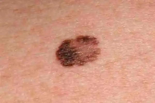 容易癌变的黑痣图片6