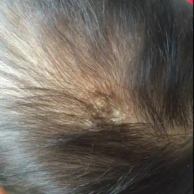 还是头皮癣,该怎样治疗