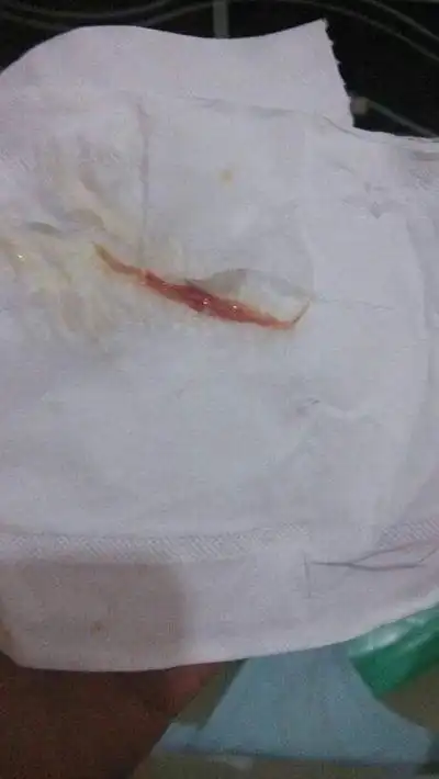 白带有血丝图片44