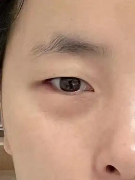 眼袋浮肿疼痛用肌贴半天的效果照片没拍出来效果实际对比很明显