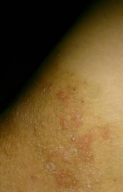 大腿内侧起了很多扁红疙瘩,很痒.请问有没有类似的.用什么药比较好?