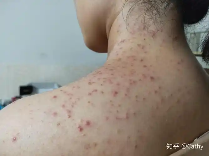 马拉色菌毛囊炎怎么治