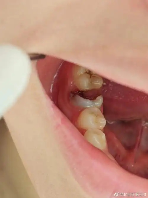 今天上班真是有点生气了……图片是一个14岁小孩的下颌第一磨牙,我问
