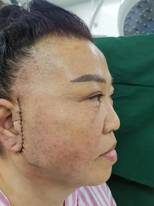 我们提倡迷你拉皮小切口,恢复后疤痕基本是不明显的,_圈子-新氧美容