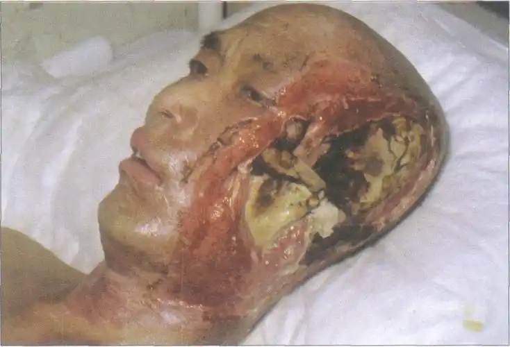 (图) 伤后50天-电烧伤手术-医学