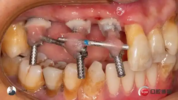 最难莫过种植桥-牙医康坚的博客-kq88口腔博客