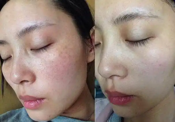 脸部皮肤敏感怎么办