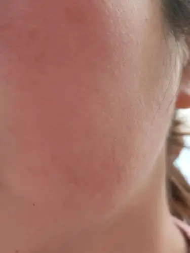 之前的皮肤红血丝特别严重,每次都有朋友问我脸上是不_圈子-新氧美容