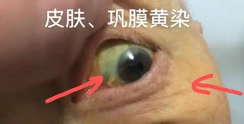 成人黄疸如何确诊治疗?