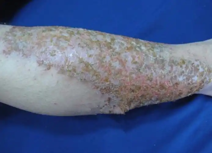 皮炎测颈多红斑图片