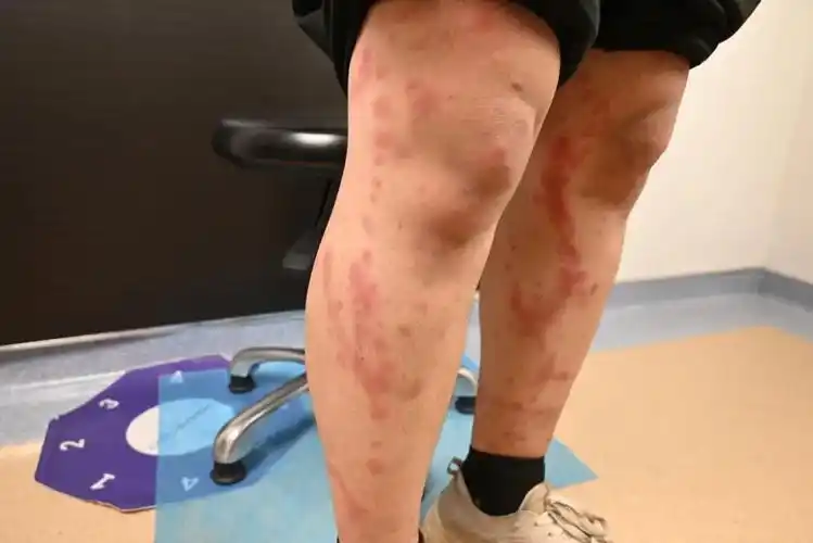 丘疹性荨麻疹是一种夏秋季节常见的过敏性皮肤病,又名急性单纯性痒疹