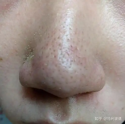 鼻头上的毛孔因为挤了几次黑头而变大,还有救吗,如果现在停手它会慢慢