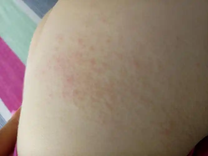 宝宝屁股上长了好多小红疙瘩,是怎么回事呢?