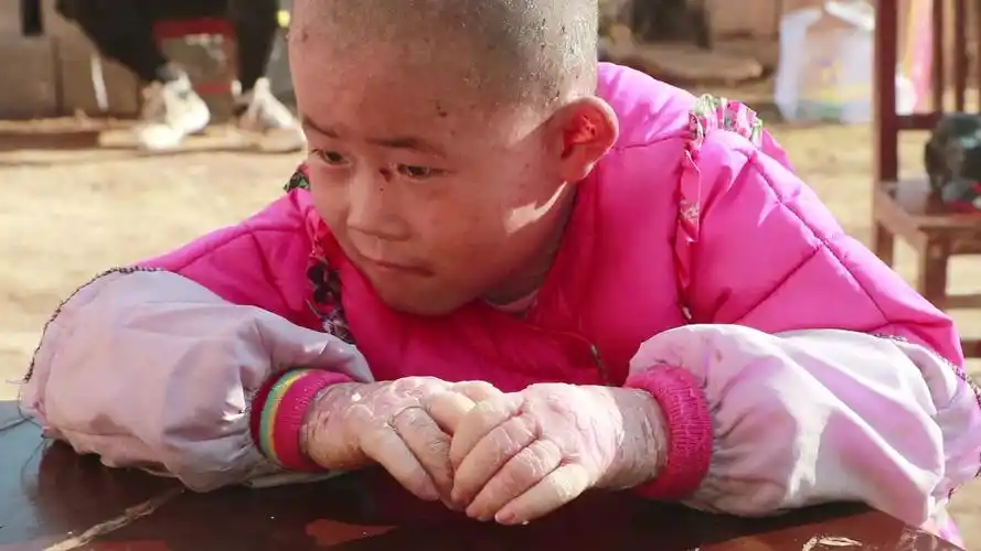 被鱼鳞病毁掉的童年,第一次见这个玩具-母婴亲子视频-搜狐视频