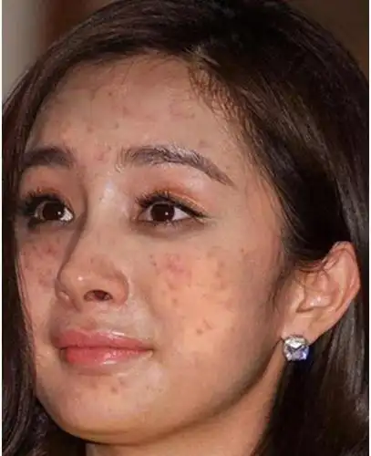 杨幂一夜变丑满脸痘痘不堪入目