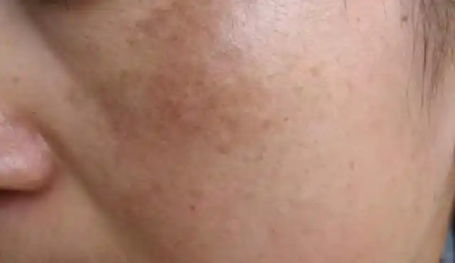 我的皮肤就开始越来越暗黄还变暗沉了,甚至还开始长斑了!