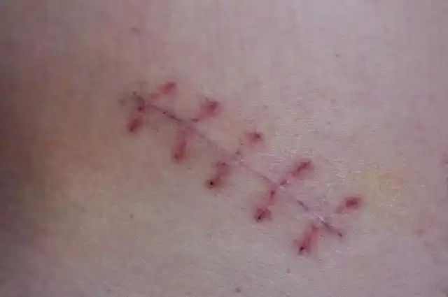 【图】缝针后如何不留疤痕 伤疤的恢复方法