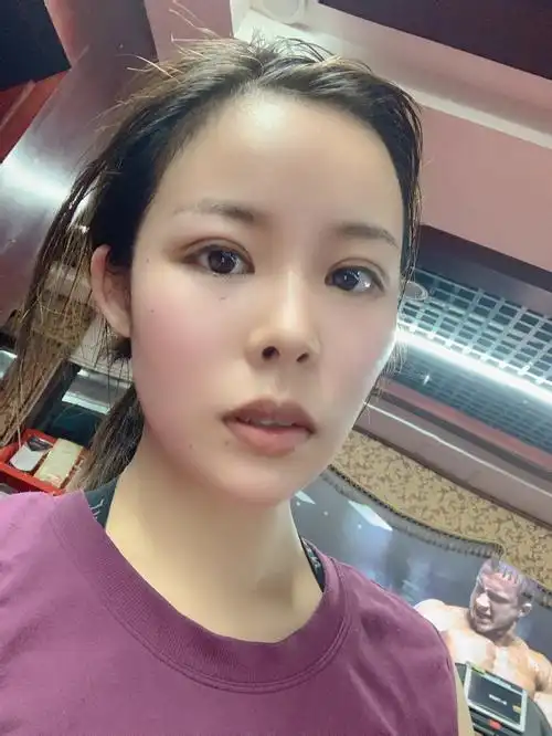 埋线双眼皮第九天8㎜