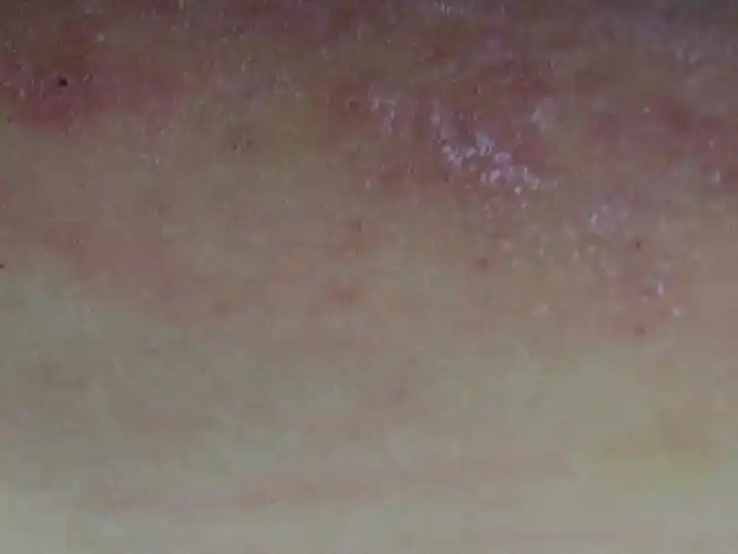 大腿肚内侧红疹是湿疹还是股癣