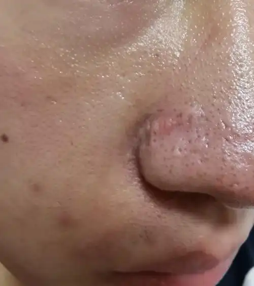 鼻子毛孔粗大怎么办 脸上鼻子毛孔粗大怎么办-蜀川号