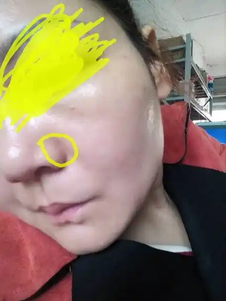 鼻子两侧凹沟黑色一道怎么能消失,年轻的时候粉刺多挤得,照片因为涂了