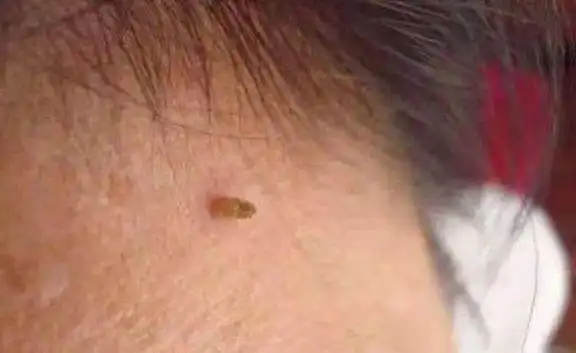 hpv脖子皮肤疣图片,脖子hpv感染的图片