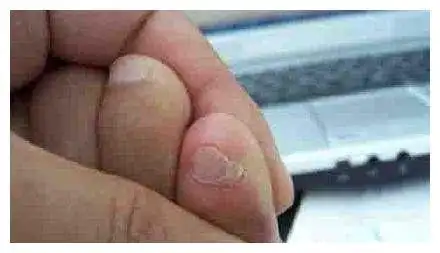 如果脚趾有这个特征那你可能不是纯血统的汉族人而是鲜卑族人