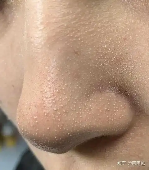 鼻子上黑头很严重,毛孔粗大,怎么办? - 知乎