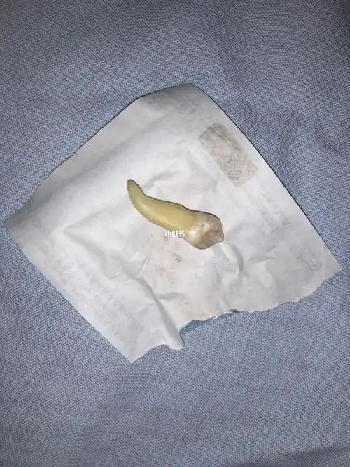 可想而知虎牙根是有多长拔掉了歪歪扭扭的虎牙(根部都很歪)希望以后的