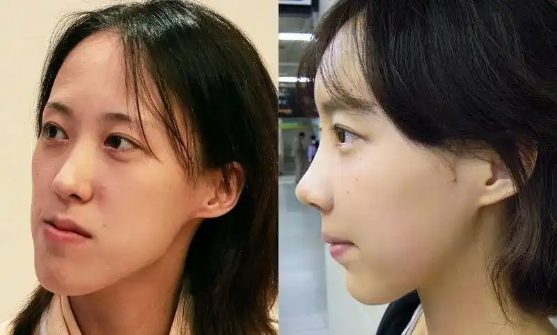 当你还跟你的眼睛鼻子死磕的时候,其实不妨看看你周围戴过牙套的朋友