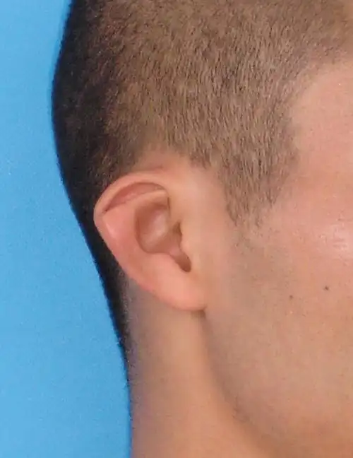 各式各样的耳廓畸形-猿耳