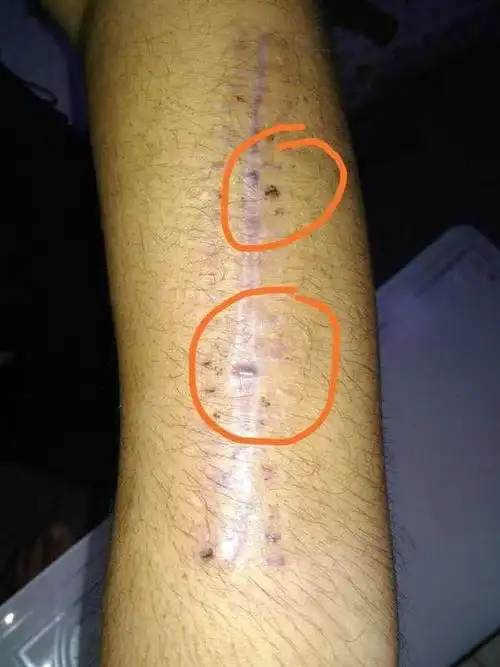 手术后伤口线头反应