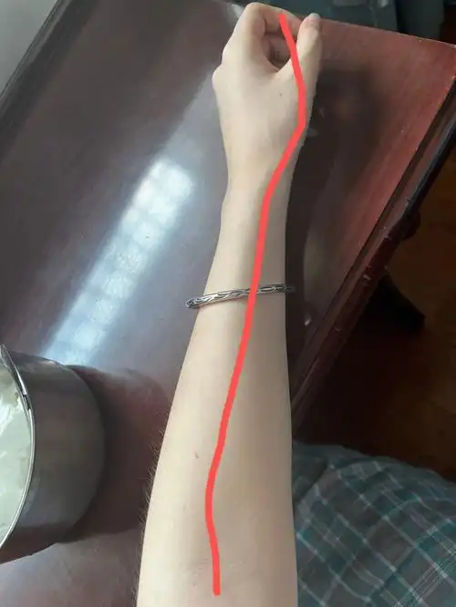 我左手臂的痣超级神奇如果把手臂伸直手掌也伸直的话 就有六颗痣可以