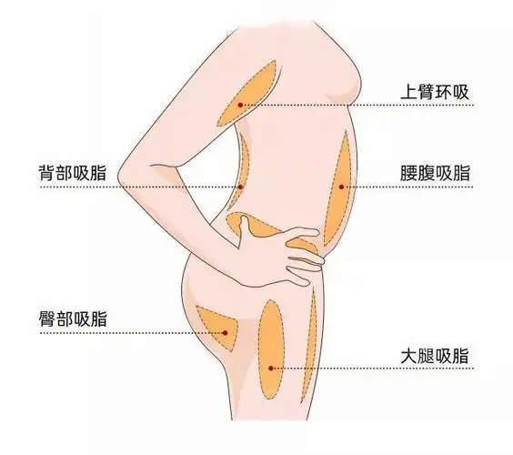 吸脂手术原理是什么直击腹部吸脂手术全过程