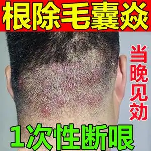 治疗头皮毛囊炎专用头部脖子前胸后背痘痘私处马拉色菌中药酊膏药