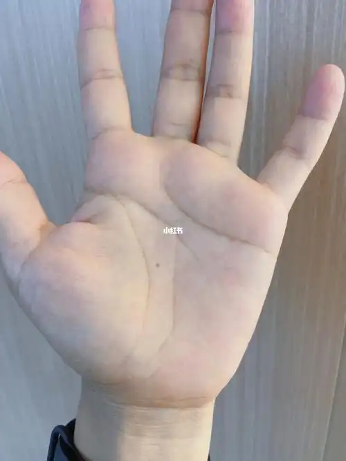手心有痣