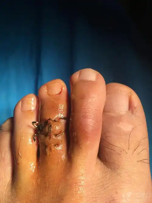 第三脚趾骨折,打入钢钉后两周,有几个问题咨询?