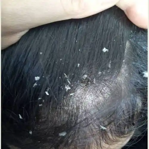 头屑多头痒用什么洗发水最好?强力去油去屑的洗发水__