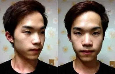 男生割双眼皮前后对比照片