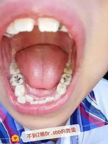 儿童蛀牙的危害到底有多大?