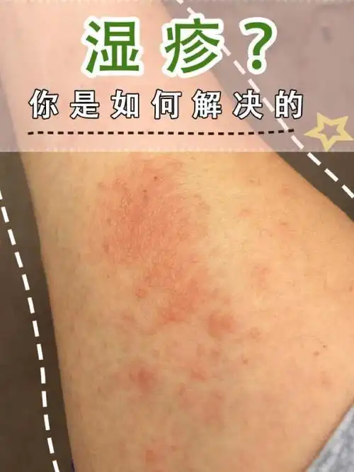 湿疹/皮肤过敏/皮炎/红丘疹/湿气/皮肤估计/湿疹这个磨人的小妖精现在