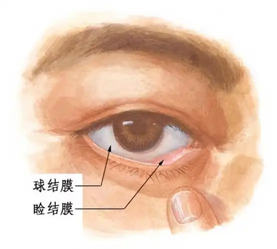 结膜是由覆盖于上下眼睑内面的睑结膜,位于眼球前部巩膜表面的球结膜