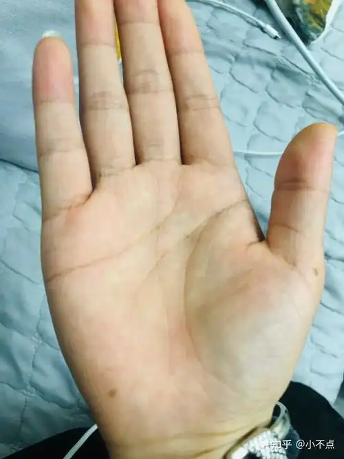 右手上三颗痣是代表什么