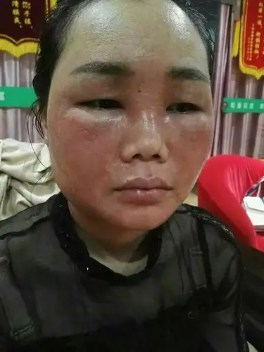 乳腺增生调理,脸部化妆品过敏调理后效果!