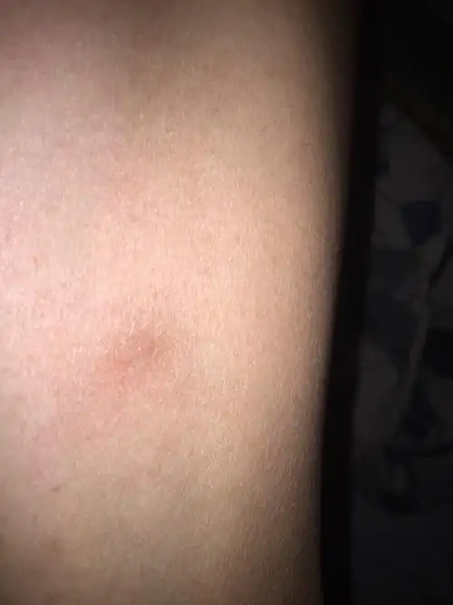 右大腿内测长了一个肿块,摸起来约红豆不小,不痛不痒,按住也不疼