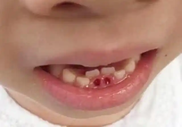 7岁男孩长双排牙,医生建议一颗颗全拔掉,得知诱因的奶奶悔不迭