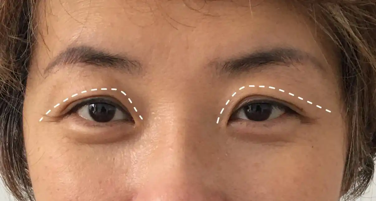 北京西美整形医院刘野院长造成眼部松弛的原因