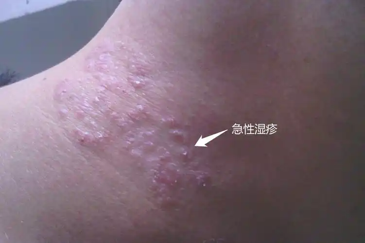 血毒湿疹皮肤的图片_图文_文章_美咯_让您放心美!